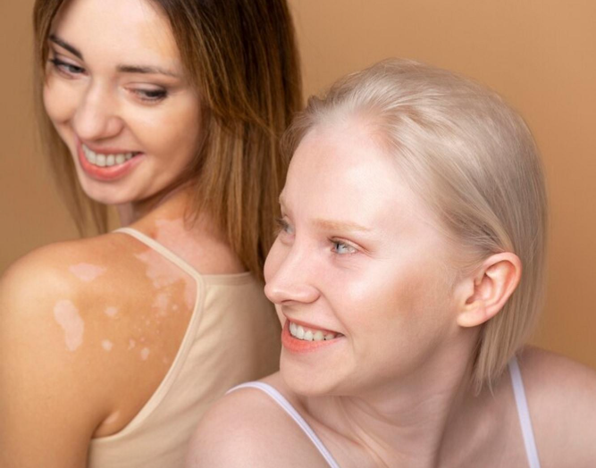 vitiligo womens