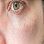 Syringoma Removal in Riyadh