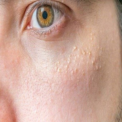 Comprehensive Syringoma Removal Strategies for Long-Term Beauty Gains Syringoma Removal in Riyadh