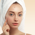 Acne Treatment In Dubai