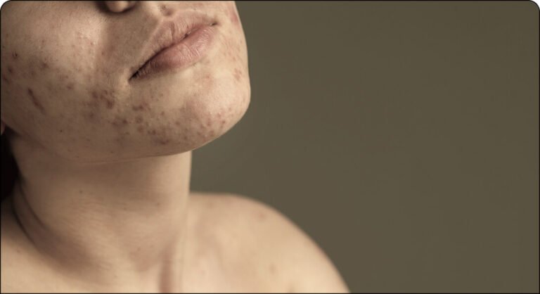 Acne