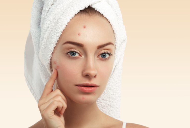Acne Treatment In Dubai