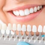 Veneers Dubai