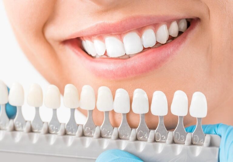 Veneers Dubai: Porcelain vs Composite Veneers Comparison Veneers Dubai
