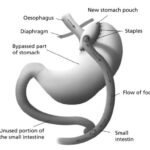 gastric bypass in Islamabad
