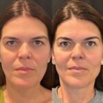 Best Aesthetic Clinic in Dubai for Long Lasting Facial Thread Lift For Face