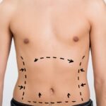 Liposuction in Islamabad