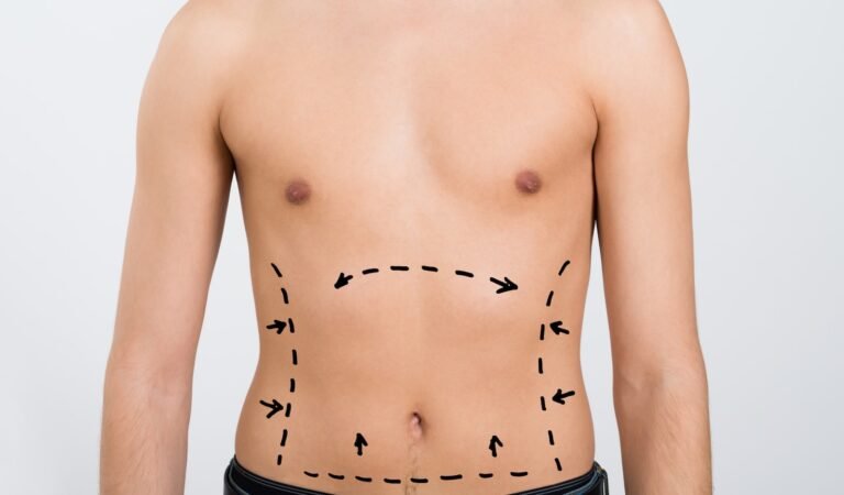 Liposuction in Islamabad
