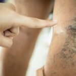 Spider Vein Specialist Astoria