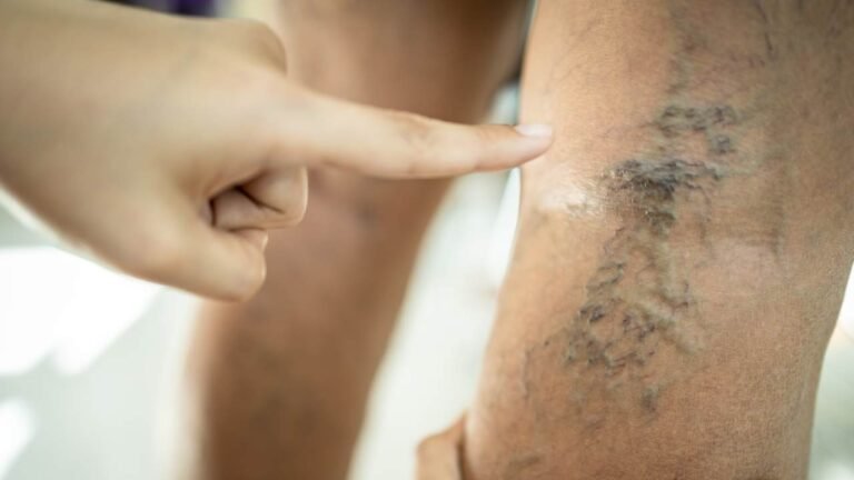 Spider Vein Specialist Astoria