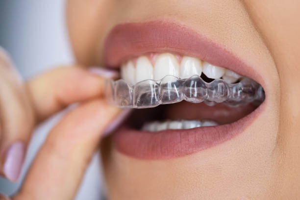 Why More Adults and Teens Are Embracing Clear Aligner Treatment for Straighter Smiles