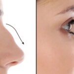 Septoplasty in Dubai