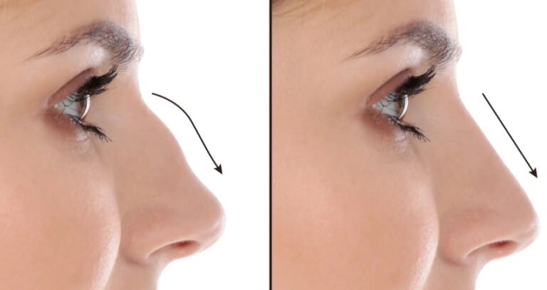 Septoplasty in Dubai